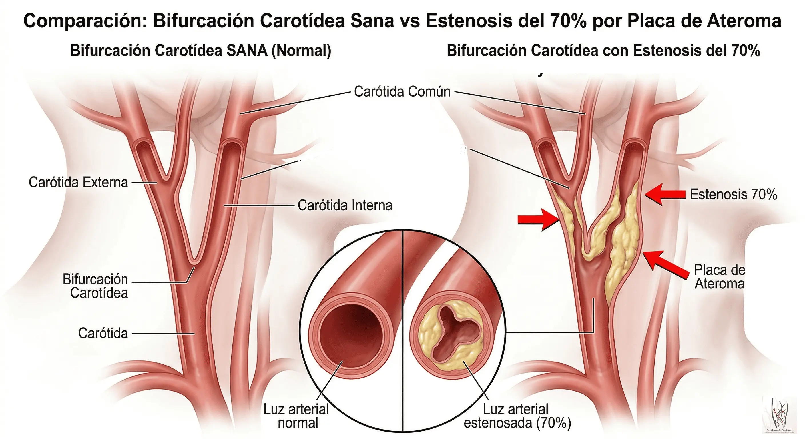 Enfermedad Carotídea